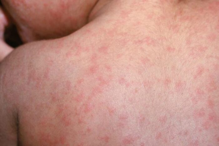 Refuerzan vigilancia sanitaria en Matamoros ante brote de sarampión cercano