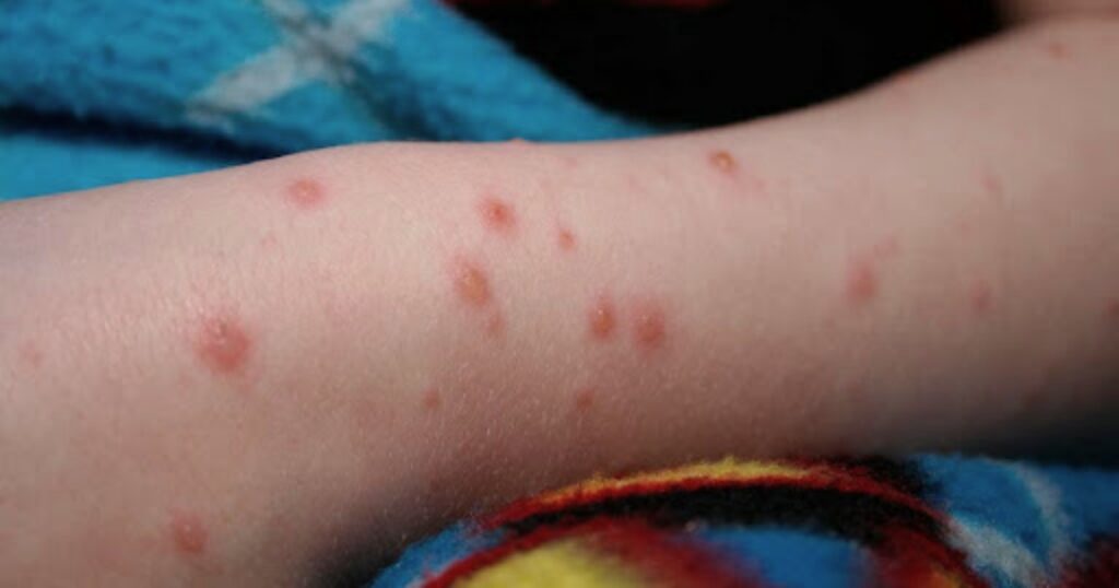 Salud descarta brote de sarampión en primaria de Reynosa Salud descarta brote de sarampión en primaria de Reynosa