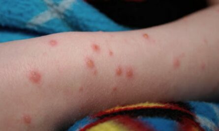 Salud descarta brote de sarampión en primaria de Reynosa